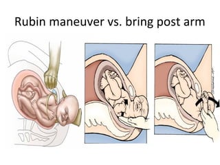 Rubin maneuver vs. bring post arm
 