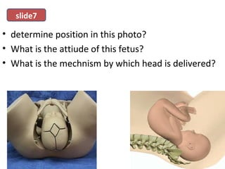 • determine position in this photo?
• What is the attiude of this fetus?
• What is the mechnism by which head is delivered?
slide7
 