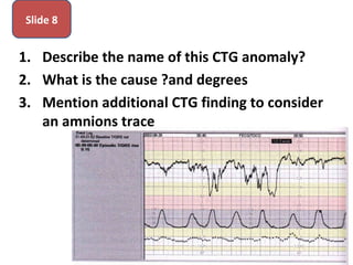 1. Describe the name of this CTG anomaly?
2. What is the cause ?and degrees
3. Mention additional CTG finding to consider
an amnions trace
Slide 8
 