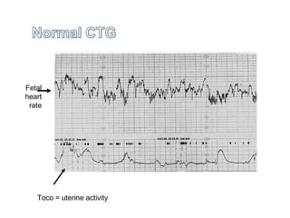 Toco = uterine activity
Fetal
heart
rate
 