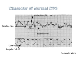 Baseline rate
Contractions
Irregular 1-2:10
Variability = 20 bpm
accelerations
No decelerations
 