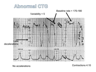 Baseline rate = 170-180
Variability = 5
No accelerations Contractions 4:10
Late
decelerations
 