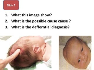 1. What this image show?
2. What is the possible cause cause ?
3. What is the defferntial diagnosis?
Slide 9
 