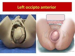 Left occipto anterior
 