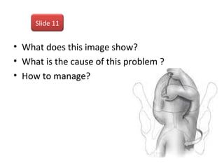 • What does this image show?
• What is the cause of this problem ?
• How to manage?
Slide 11
 