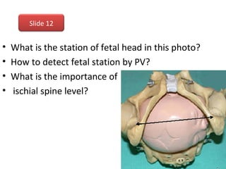 • What is the station of fetal head in this photo?
• How to detect fetal station by PV?
• What is the importance of
• ischial spine level?
Slide 12
 
