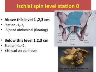 Ischial spin level station 0
• Above this level 1 ,2,3 cm
• Station -1,-2,
• -3(head abdominal (floating)
• Below this level 1,2,3 cm
• Station +1,+2,
• +3(head on perineum
 