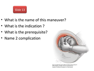 • What is the name of this maneuver?
• What is the indication ?
• What is the prerequisite?
• Name 2 complication
Slide 13
 