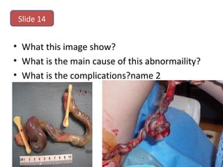• What this image show?
• What is the main cause of this abnormaility?
• What is the complications?name 2
Slide 14
 