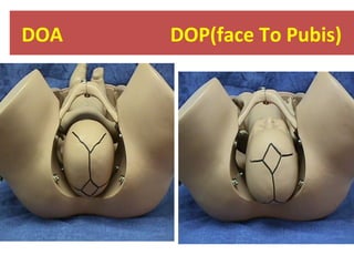 DOA DOP(face To Pubis)
 