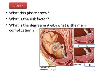• What this photo show?
• What is the risk factor?
• What is the degree in A &B?what is the main
complication ?
A
B
Slide17
 