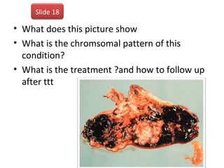 • What does this picture show
• What is the chromsomal pattern of this
condition?
• What is the treatment ?and how to follow up
after ttt
Slide 18
 