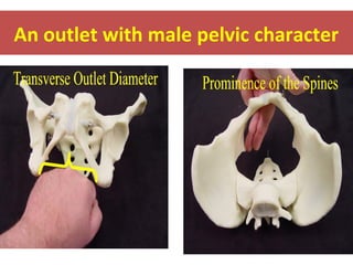 An outlet with male pelvic character
 