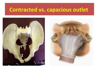 Contracted vs. capacious outlet
 