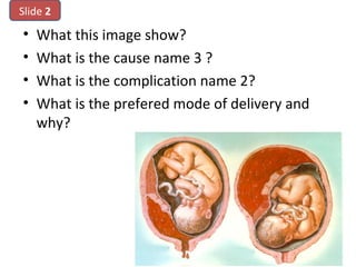 • What this image show?
• What is the cause name 3 ?
• What is the complication name 2?
• What is the prefered mode of delivery and
why?
Slide 2
 