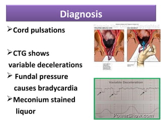 Diagnosis
Cord pulsations
CTG shows
variable decelerations
 Fundal pressure
causes bradycardia
Meconium stained
liquor
 