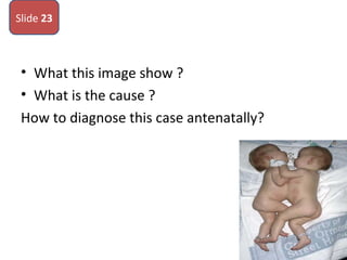 • What this image show ?
• What is the cause ?
How to diagnose this case antenatally?
Slide 23
 
