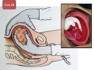• What is the name of this maneuver ?
• What is the indications
• Name 2 complications
Slide 24
 