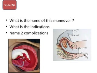 • What is the name of this maneuver ?
• What is the indications
• Name 2 complications
Slide 24
 