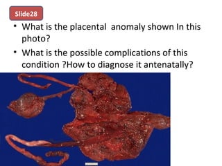 • What is the placental anomaly shown In this
photo?
• What is the possible complications of this
condition ?How to diagnose it antenatally?
Slide28
 