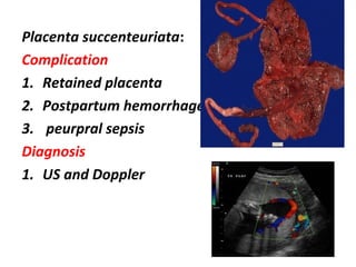 Placenta succenteuriata:
Complication
1. Retained placenta
2. Postpartum hemorrhage
3. peurpral sepsis
Diagnosis
1. US and Doppler
 