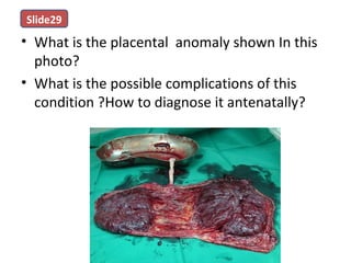 • What is the placental anomaly shown In this
photo?
• What is the possible complications of this
condition ?How to diagnose it antenatally?
Slide29
 