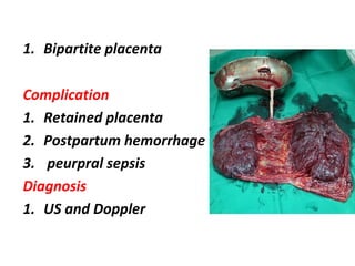 1. Bipartite placenta
Complication
1. Retained placenta
2. Postpartum hemorrhage
3. peurpral sepsis
Diagnosis
1. US and Doppler
 