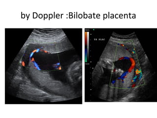 by Doppler :Bilobate placenta
 