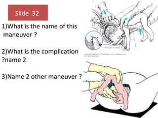 Slide 32
1)What is the name of this
maneuver ?
2)What is the complication
?name 2
3)Name 2 other maneuver ?
 