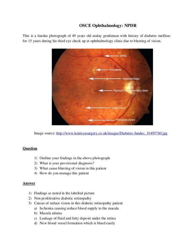 Osce ophthalmology npdr