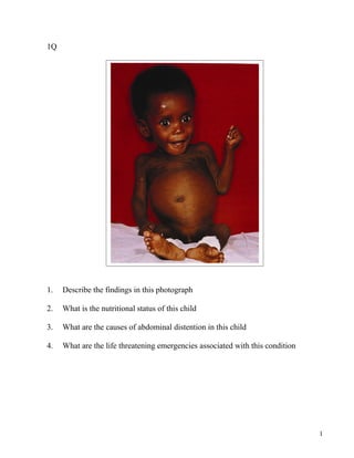1Q




1.   Describe the findings in this photograph

2.   What is the nutritional status of this child

3.   What are the...
