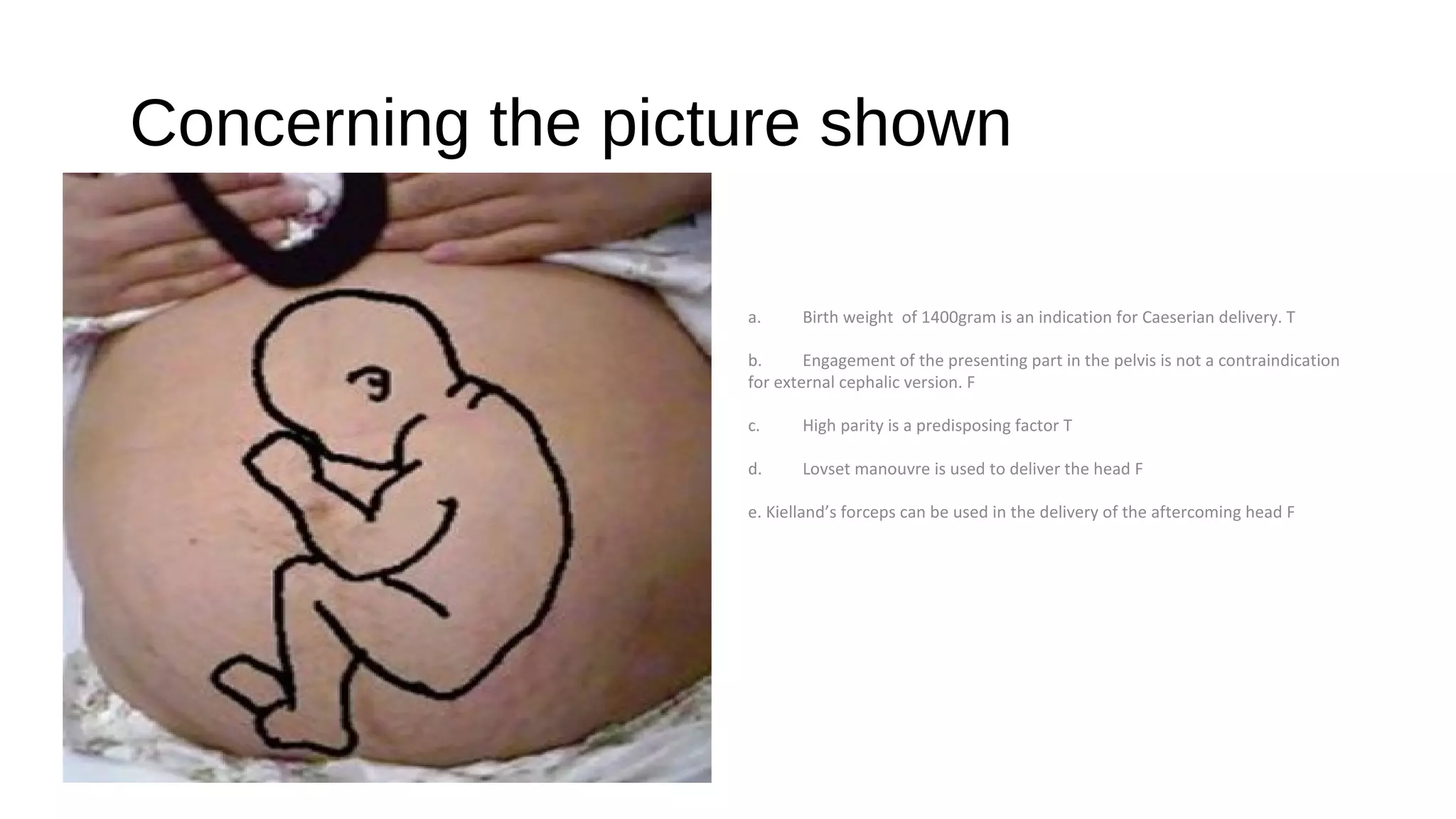 Concerning the picture shown
a. Birth weight of 1400gram is an indication for Caeserian delivery. T
b. Engagement of the presenting part in the pelvis is not a contraindication
for external cephalic version. F
c. High parity is a predisposing factor T
d. Lovset manouvre is used to deliver the head F
e. Kielland’s forceps can be used in the delivery of the aftercoming head F
 