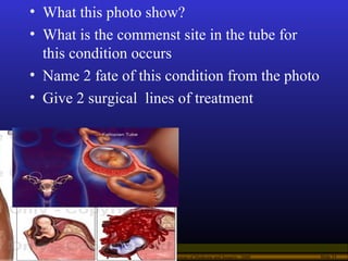 Operational Obstetrics & Gynecology · Bureau of Medicine and Surgery · 2000 Slide 33
• What this photo show?
• What is the...