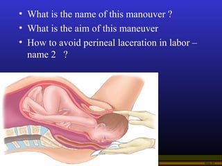 Operational Obstetrics & Gynecology · Bureau of Medicine and Surgery · 2000 Slide 45
• What is the name of this manouver ?...