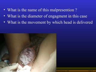 Operational Obstetrics & Gynecology · Bureau of Medicine and Surgery · 2000 Slide 55
• What is the name of this malpresent...