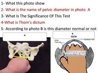 A
1- What this photo show
2- What is the name of pelvic diameter in photo A
3- What Is The Significance Of This Test
4-Wha...