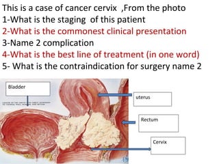 Bladder
Rectum
uterus
Cervix
This is a case of cancer cervix ,From the photo
1-What is the staging of this patient
2-What ...