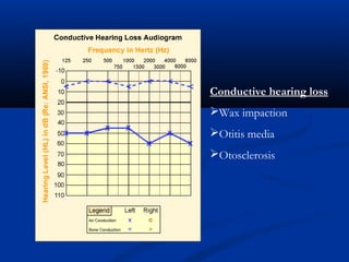 Conductive hearing loss
Wax impaction
Otitis media
Otosclerosis
 