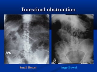 Intestinal obstruction
Intestinal obstruction
Small Bowel large Bowel
 