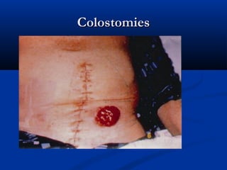 Colostomies
Colostomies
 