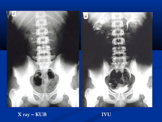 X ray – KUB IVU
 