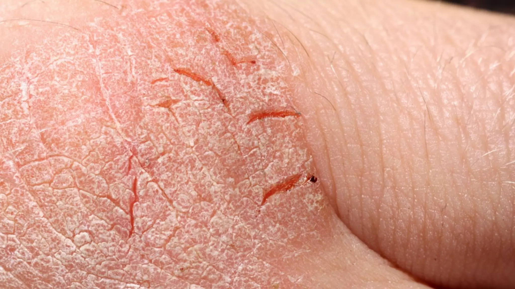 Psoriasis
 