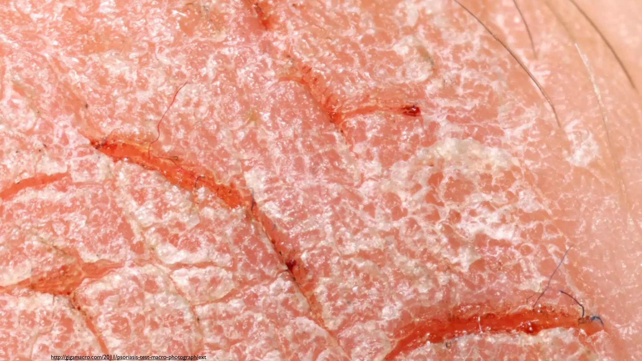 Psoriasis   http://gigamacro.com/2011/psoriasis-test-macro-photograph/ext
 