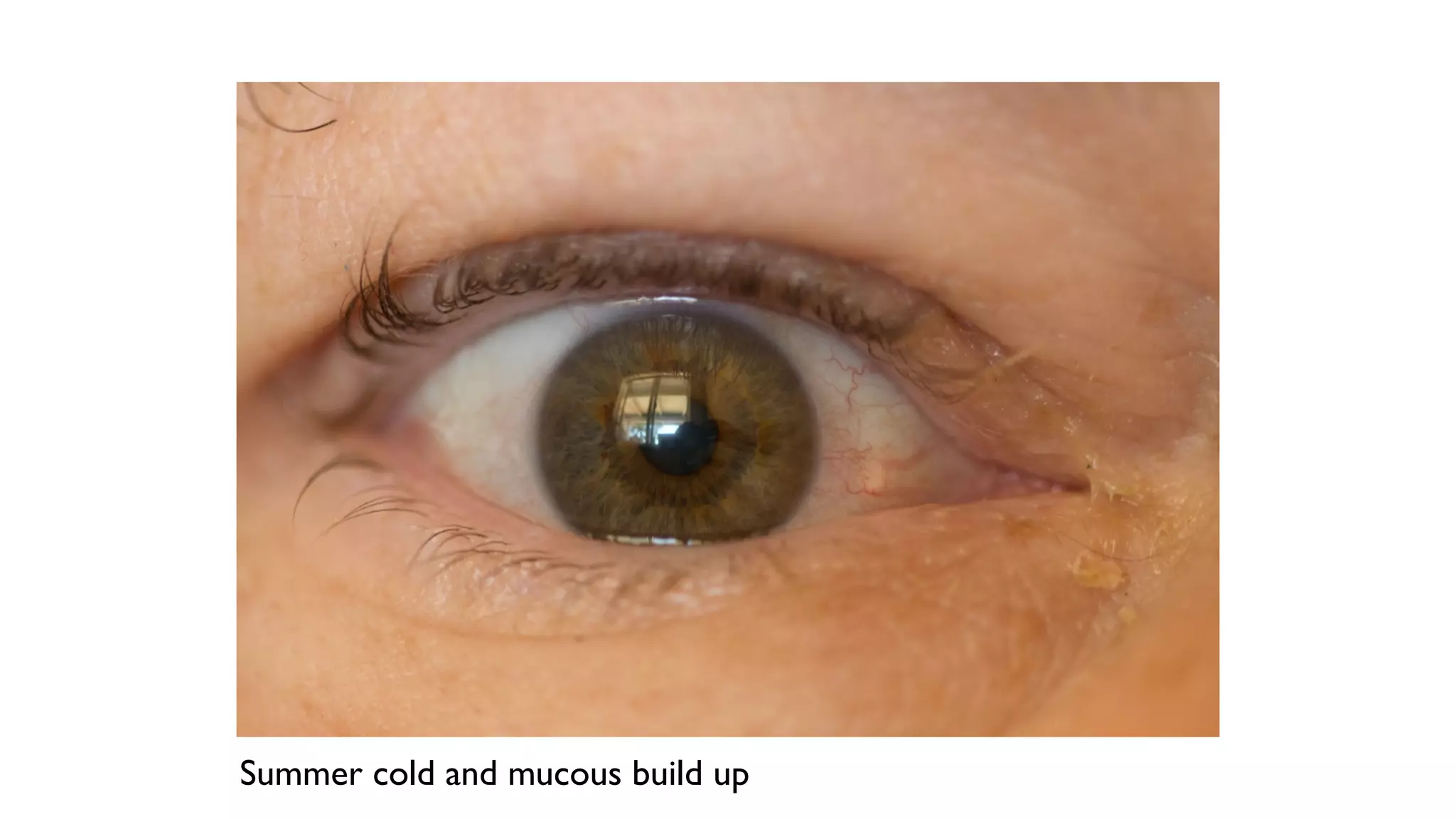 Summer cold and mucous build up
 