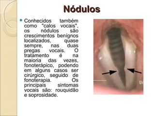 NódulosNódulos
 Conhecidos também
como "calos vocais",
os nódulos são
crescimentos benígnos
localizados, quase
sempre, nas duas
pregas vocais. O
tratamento é na
maioria das vezes,
fonoterápico, podendo
em alguns casos ser
cirúrgico, seguido de
fonoterapia. Os
principais sintomas
vocais são: rouquidão
e soprosidade.
 