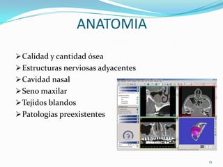 ANATOMIA
 Calidad y cantidad ósea
 Estructuras nerviosas adyacentes
 Cavidad nasal
 Seno maxilar
 Tejidos blandos
 Patologías preexistentes




                                     15
 
