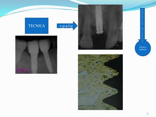 C
                        o
                        n
                        t
                        a
                        c
                        t
                        o
TECNICA   c.p.a.l.p
                        d
                        i
                        r
                        e
                        c
                        t
                        o

                       Hueso e
                      implante




                                 3
 