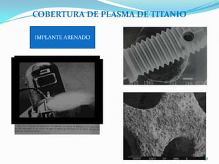 COBERTURA DE PLASMA DE TITANIO

IMPLANTE ARENADO




                                 38
 