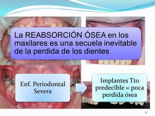 Implantes Tto
Enf. Periodontal
                   predecible = poca
     Severa
                      perdida ósea

                                       47
 