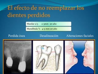 El efecto de no reemplazar los
dientes perdidos
               Maxilar 2/3    2-3mm 1er año

               Mandibula ¾ 4-5 mm 1er año


Perdida ósea                 Desalineación    Alteraciones faciales
 